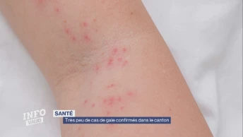 Très peu de cas de gale confirmés dans le canton