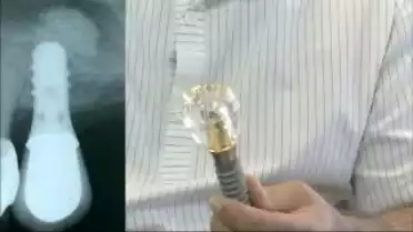 Diagnostic du 04.11.11 - Les implants dentaires 1/4