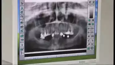 Diagnostic du 02-03.12 - Les implants dentaires - Diverses possibilités 4/4