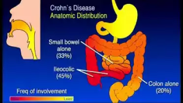 Diagnostic du 19.06.12 - La maladie de Crohn 2/4