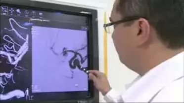 Rupture d&#039;anévrisme cérébrale (2/2)