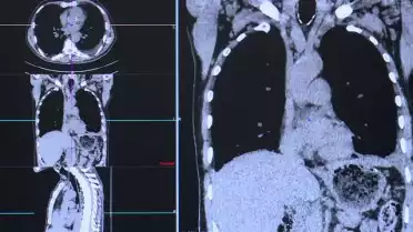 L&#039;impact de l&#039;amiante sur la santé