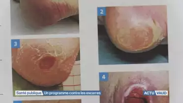 Les escarres. une plaie pour les milieux hospitaliers