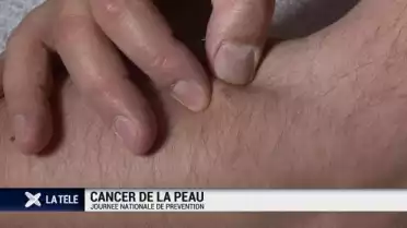 250 suisses décèdent chaque année d&#039;un cancer de la peau