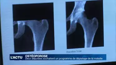 Un programme pour mieux prévenir et dépister l&#039;ostéoporose