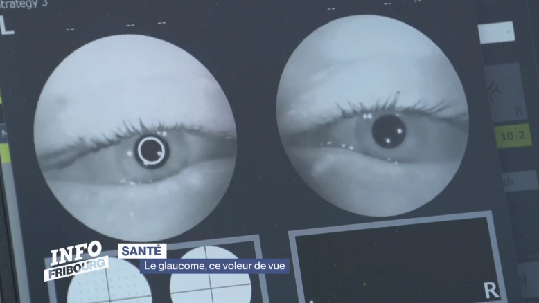 Le glaucome, ce voleur de vue