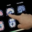 Alzheimer: premier test sanguin de dépistage validé aux Etats-Unis