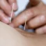 Acupuncture et homéopathie continueront d'être remboursées