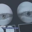 Le glaucome, ce voleur de vue
