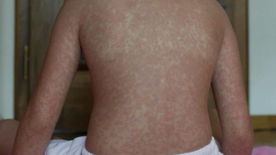 États-Unis : la pire épidémie de rougeole en 35 ans en 2026