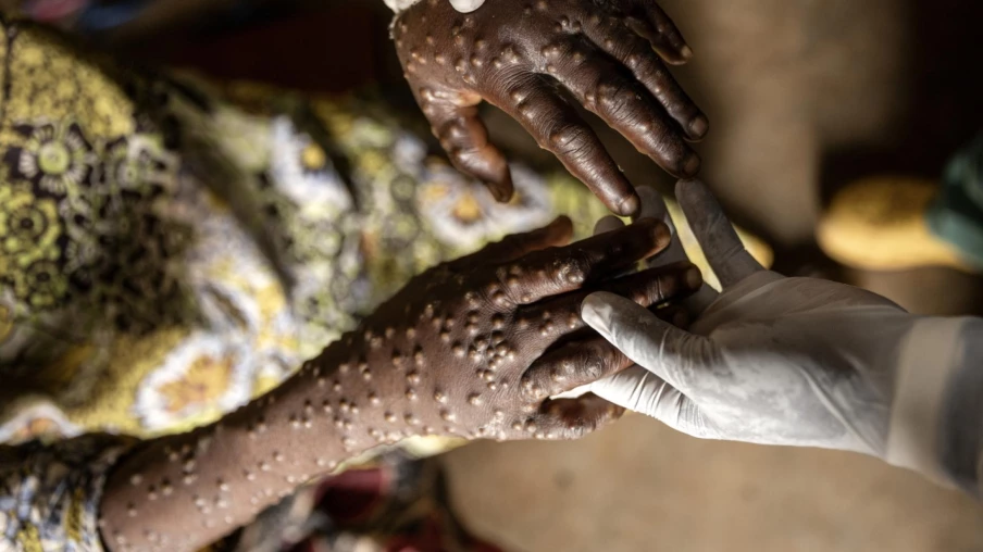 Mpox en RDC : de nombreux cas seraient de faux diagnostics, selon l’UNIGE