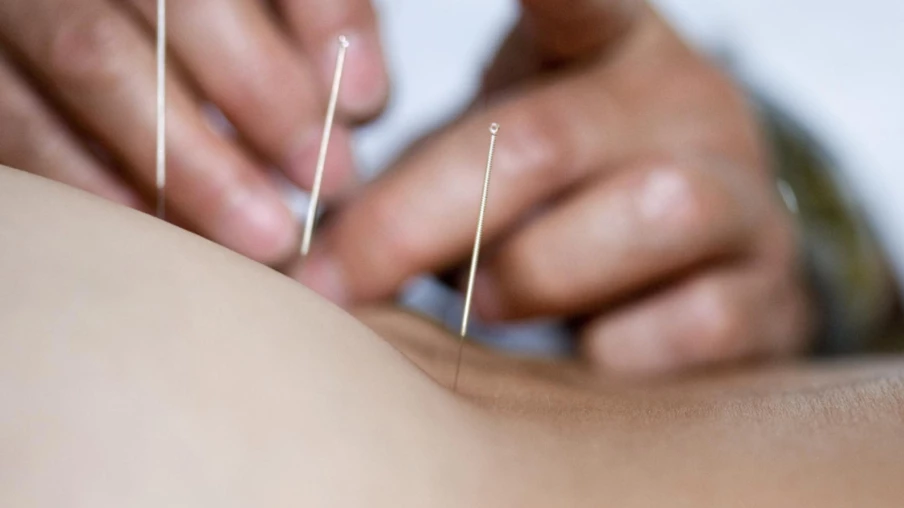 Acupuncture et homéopathie restent remboursées par l'assurance de base
